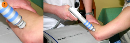 Rys. 1 ESWT – extracorporeal shock wave therapy, czyli terapia falą uderzeniową. Rys. 1 ESWT – extracorporeal shock wave therapy, czyli terapia falą uderzeniową.